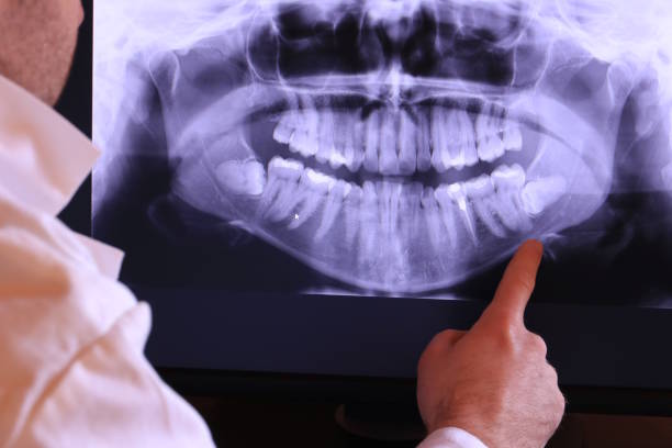Best Emergency Wisdom Teeth Removal in Palisades Park, NJ
